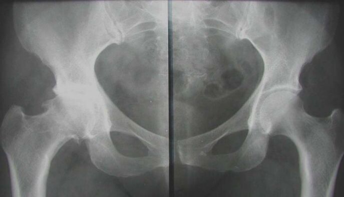 рентгенова снимка на засегнатата тазобедрена става с артроза
